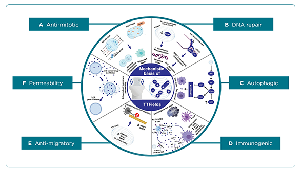 Tumor Treating Fields An Innovative Therapy for Glioblastoma and Other Solid Tumors