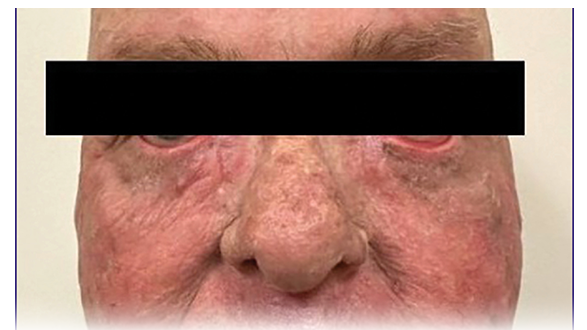 Concurrent Ocular and Dermatologic Toxicities Associated With Docetaxel Chemotherapy