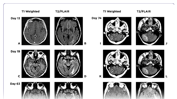 Progressive Multifocal Leukoencephalopathy in Chimeric Antigen Receptor T-Cell Therapy Recipients: A Case Study
