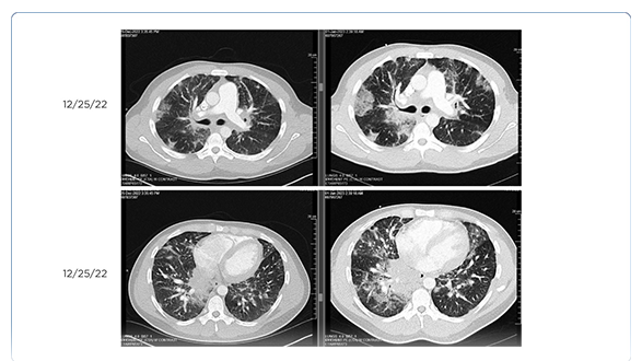 Medullary Renal Cell Carcinoma: A Case Study